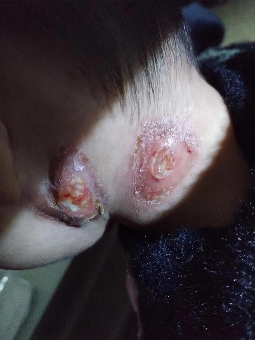 淋巴结核能治好吗