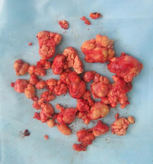 淋巴结核能治好吗