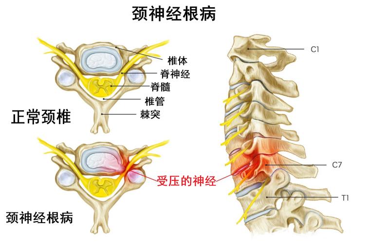 神经根型颈椎病吃什么药 神经根型颈椎病吃什么药