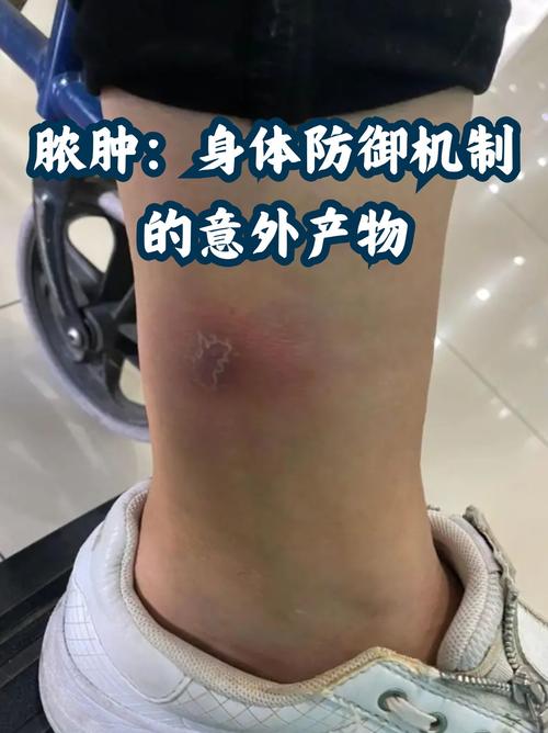 肛周脓肿切开引流后多久能好 肛周脓肿切开引流后多久能好