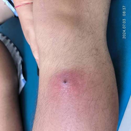 肛周脓肿切开引流后多久能好 肛周脓肿切开引流后多久能好