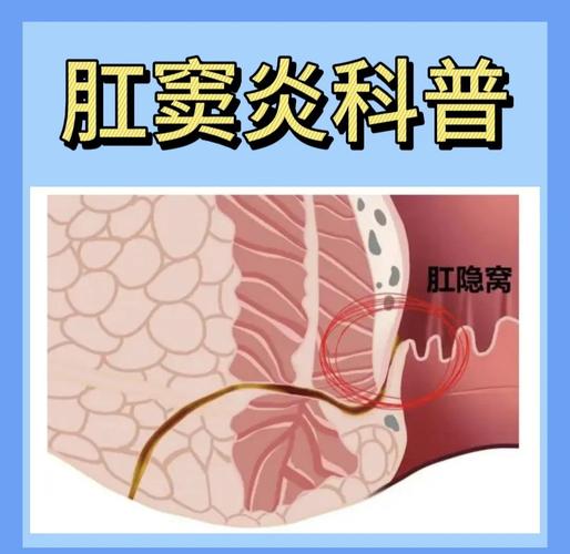 肛窦炎用什么药最好