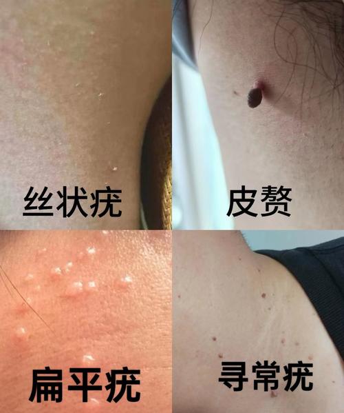 肛门皮赘怎么能消掉 肛门皮赘用什么药膏 肛门皮赘怎么能消掉 肛门皮赘用什么药膏