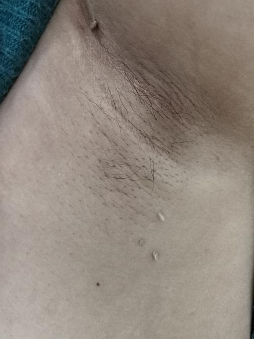 肛门皮赘怎么能消掉 肛门皮赘用什么药膏 肛门皮赘怎么能消掉 肛门皮赘用什么药膏