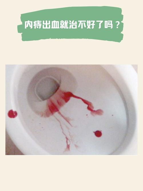 痔疮便血饮食上要注意什么 痔疮便血饮食上要注意什么