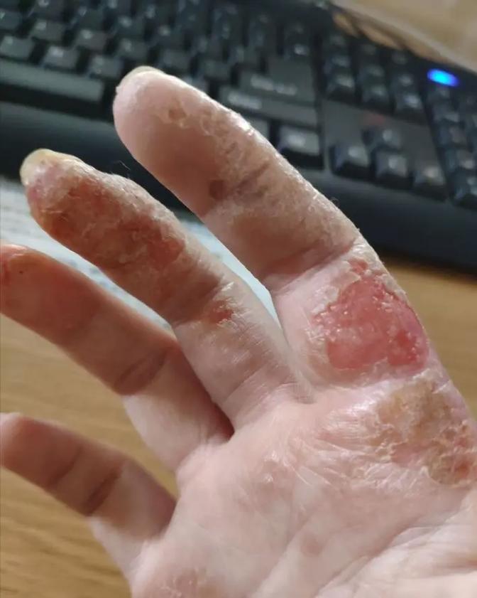 治疗湿疹最快的方法