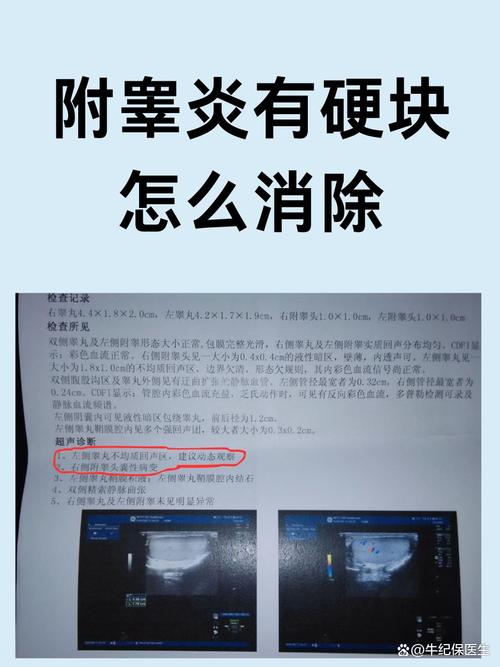 附睾丸炎的硬块多久能消除