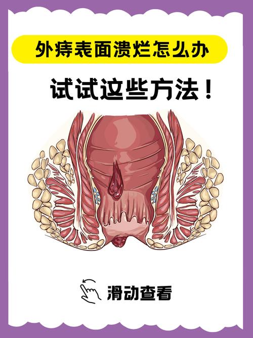 痣疮用什么药效果最好 痣疮用什么药效果最好
