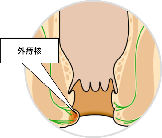 痔疮的痔核是什么 痔疮的痔核是什么
