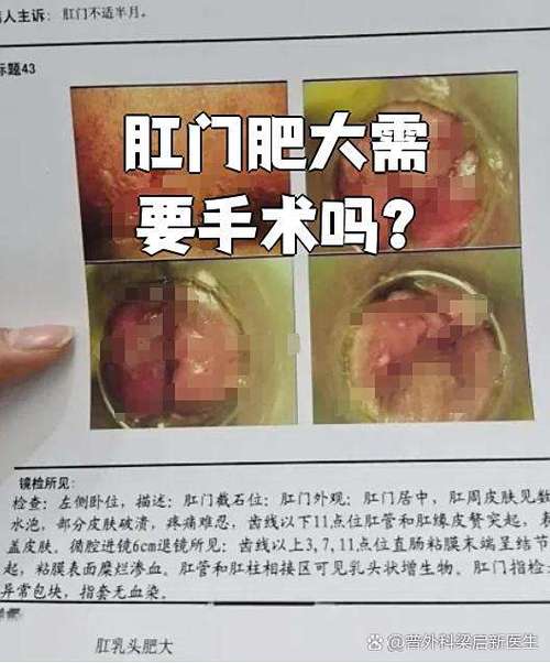 肛乳头长在什么位置 肛乳头长在什么位置