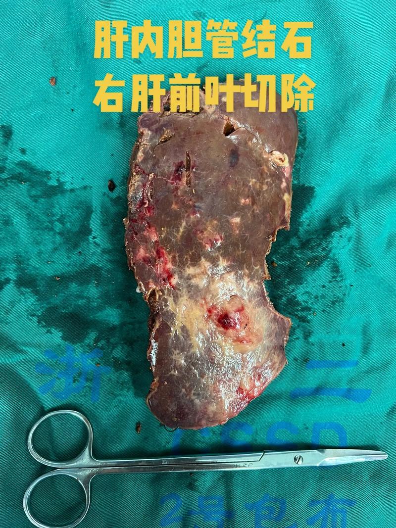 肝内胆管结石多大需要治疗