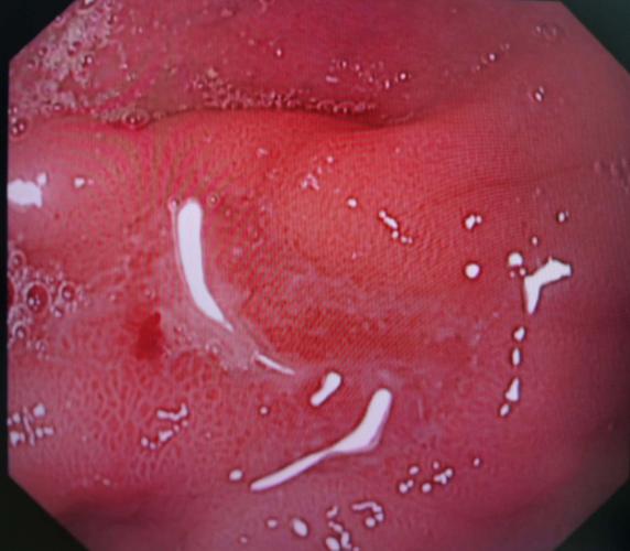 糜烂性胃炎是怎么发生的
