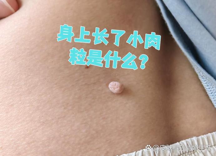 如何区分皮赘和丝状疣? 如何区分皮赘和丝状疣?