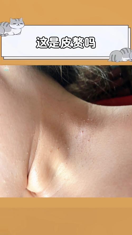 如何区分皮赘和丝状疣? 如何区分皮赘和丝状疣?