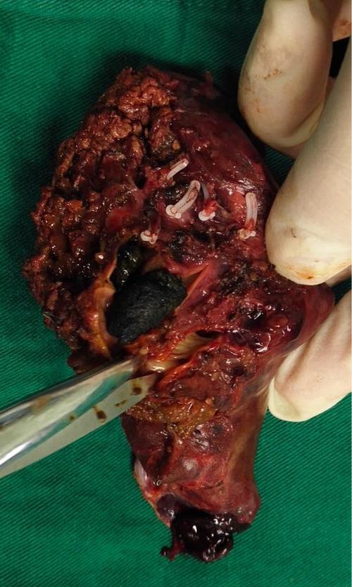 肝内胆管结石会引起哪些不适的症状 肝内胆管结石会引起哪些不适的症状