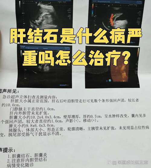 肝内胆管结石会引起哪些不适的症状 肝内胆管结石会引起哪些不适的症状