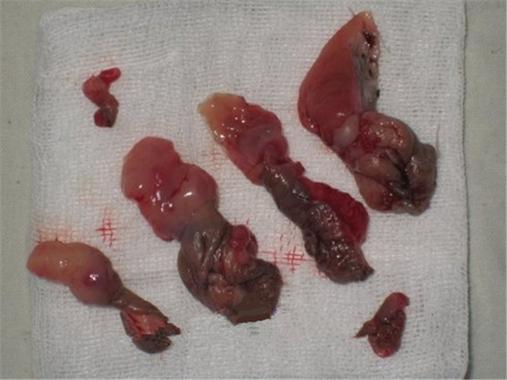 血栓痔疮和痔疮的区别 血栓痔疮和痔疮的区别