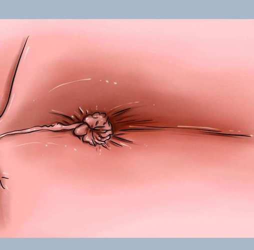 痔疮肉球脱出收不回一定要手术吗