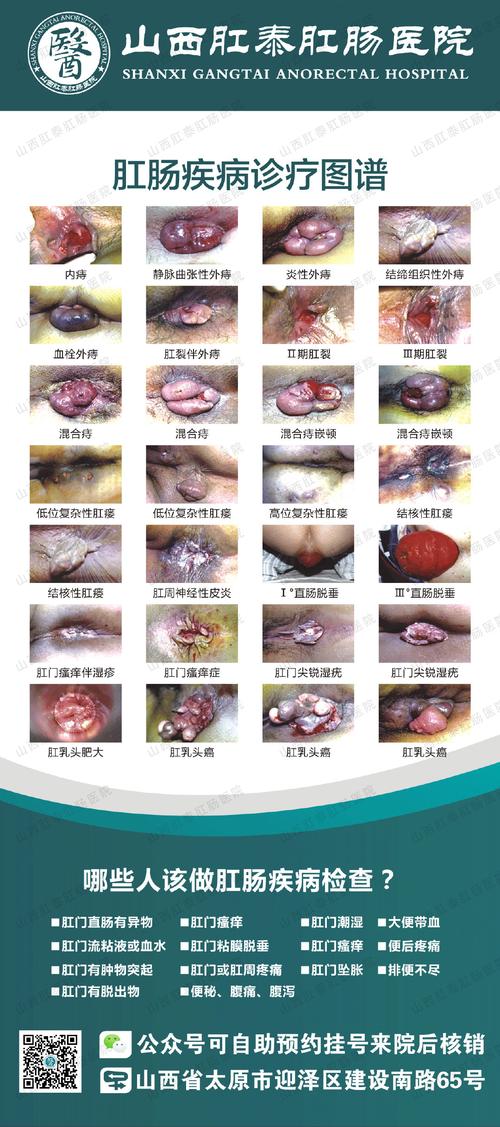 静脉曲张性外痔可以消失吗