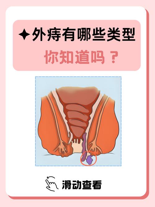 静脉曲张性外痔可以消失吗