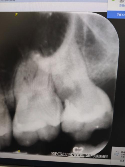 急性牙髓炎是怎么样的