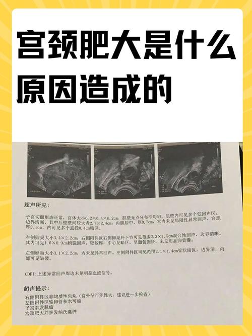 宫颈肥大是什么原因造成 宫颈肥大是什么原因造成