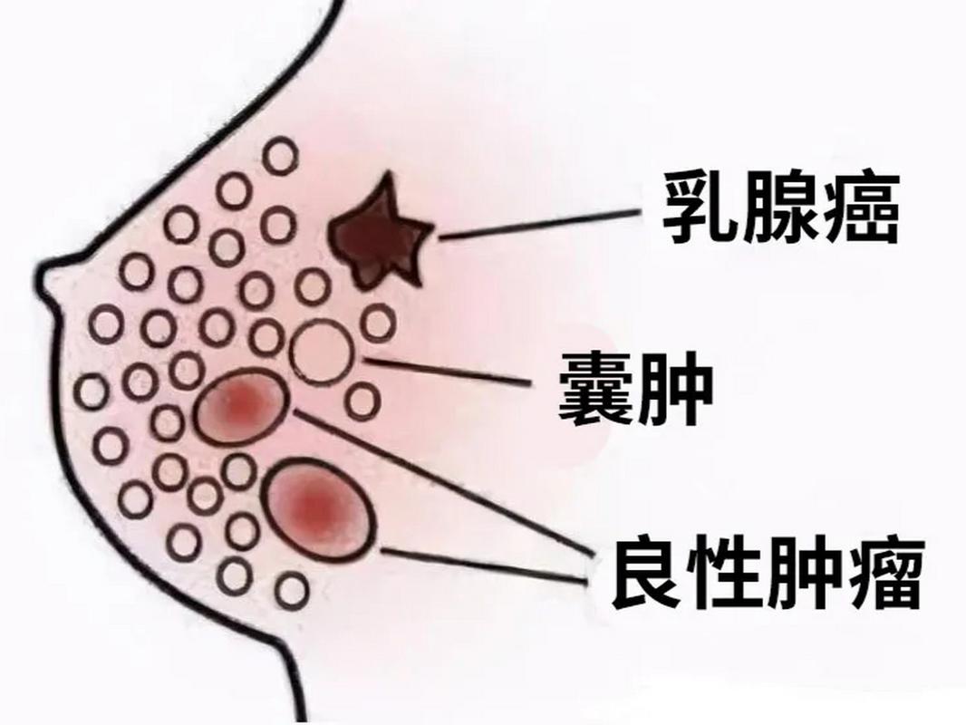 乳腺增生肿块怎么消除