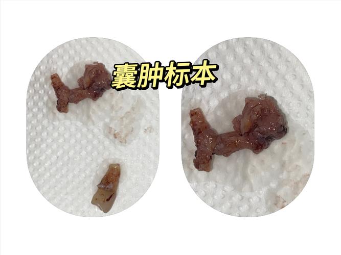 肿瘤和囊肿的区别 肿瘤和囊肿的区别