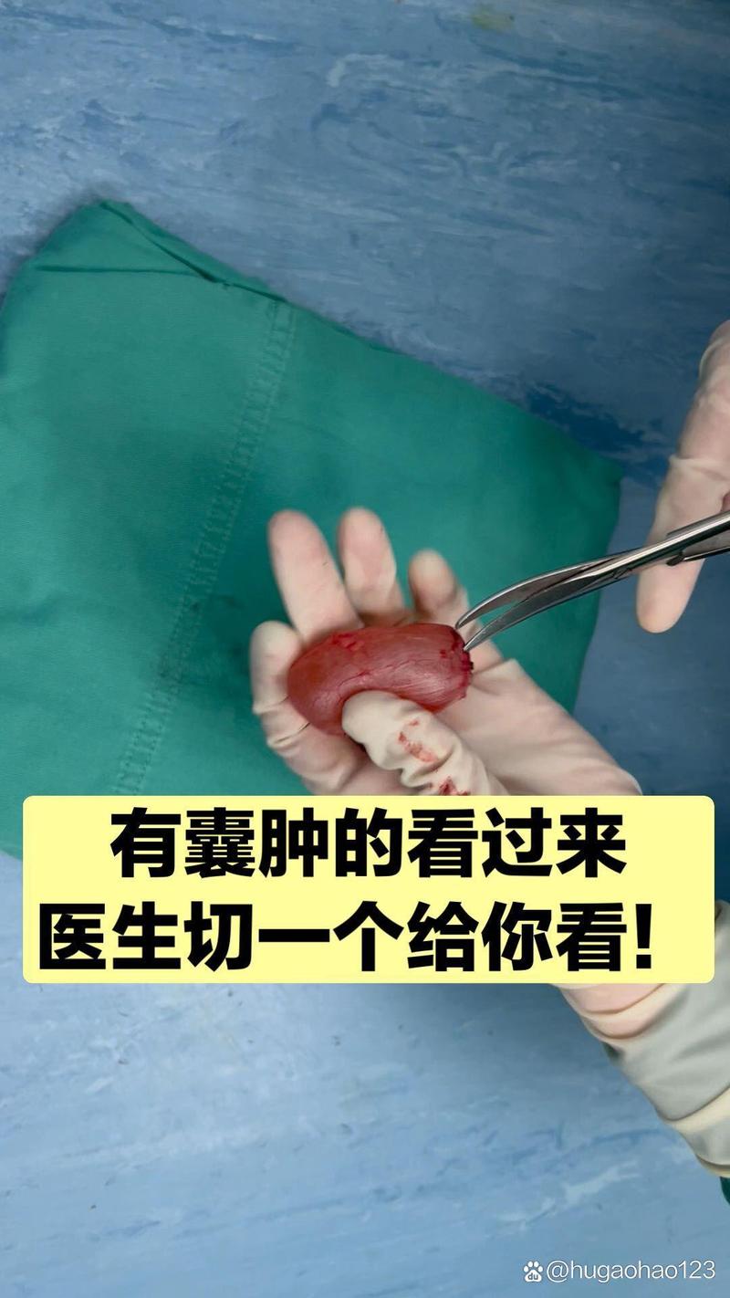 肿瘤和囊肿的区别 肿瘤和囊肿的区别