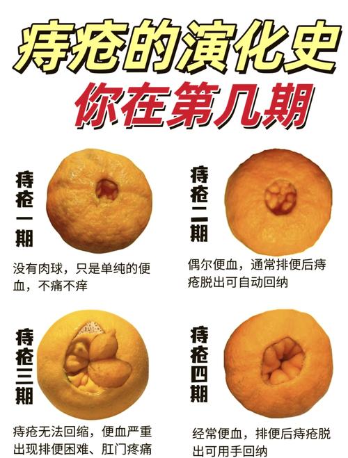 外痔早期有哪些症状 外痔早期有哪些症状