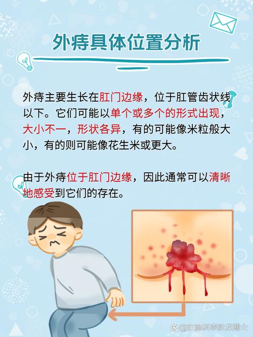 外痔早期有哪些症状 外痔早期有哪些症状