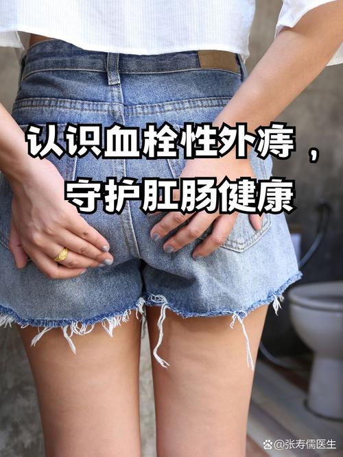 得了血栓性外痔应如何治疗应配合使用什么 得了血栓性外痔应如何治疗应配合使用什么